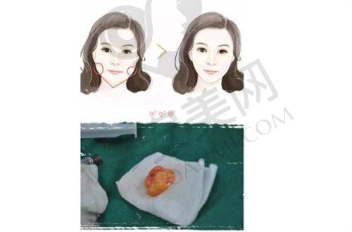 剖腹产疤痕修复后，对我的生活有什么改变？