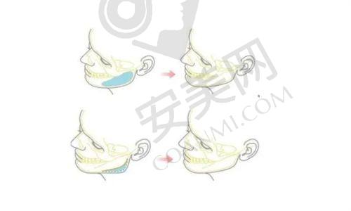 北京禾美嘉面部脂肪填充的安心性如何保护？