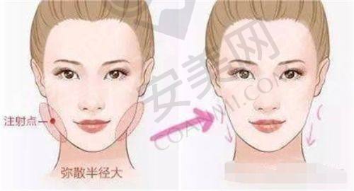 北京禾美嘉面部脂肪填充有哪些独特优势？