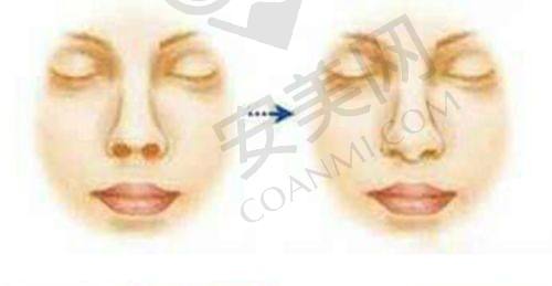 面部玻尿酸塑形后有什么成效？
