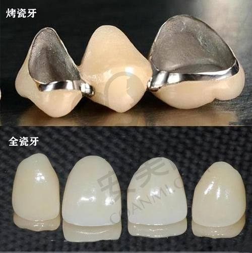 南京溧水瑞齿固德口腔的医生技术如何保护爱尔创全瓷冠的成效？