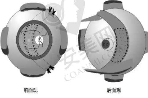 玻尿酸填充法令纹成效怎么样？