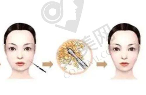 成都米兰柏羽腰腹环吸技术有多精良？
