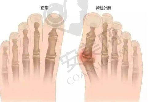 成都美容整形医院双眼皮整形术后修复需要注意什么？