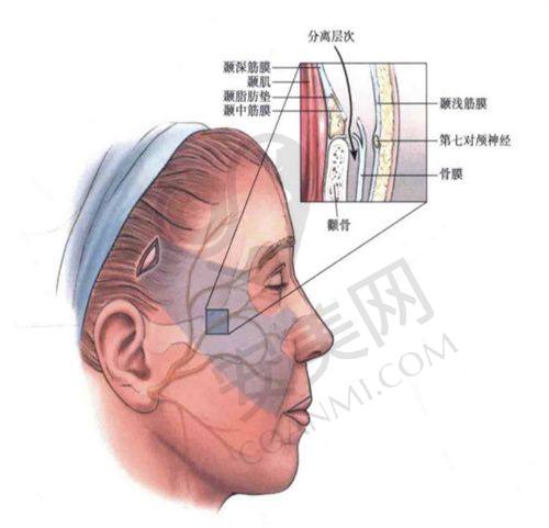 玻尿酸填充法令纹有哪些优势？