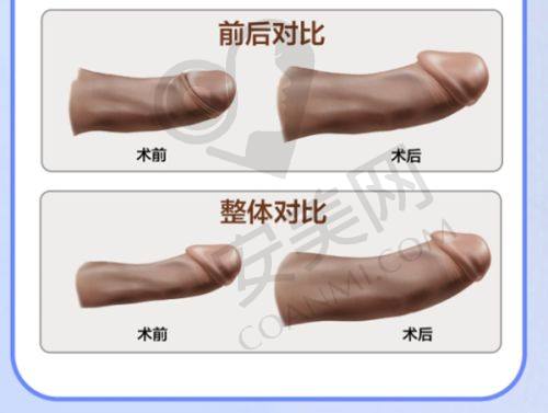 北京碧莲盛植发医院的价格可靠吗？