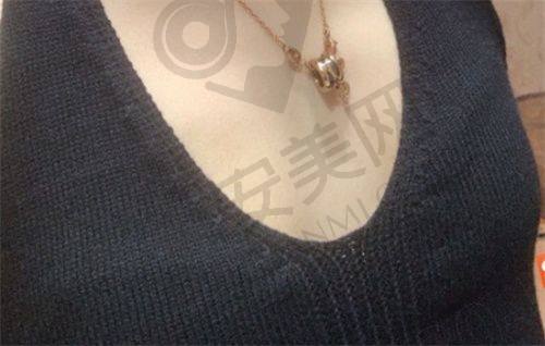 成都艾米丽医院馒化脸修复价格是怎样的？