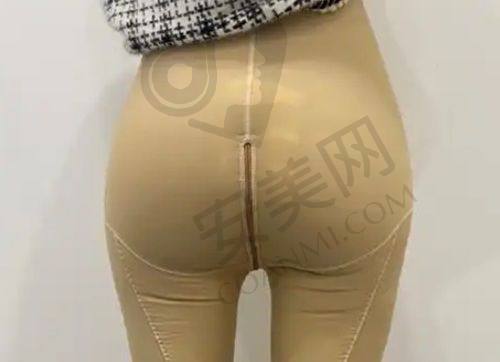 成都米兰柏羽割双眼皮医生的口碑如何？