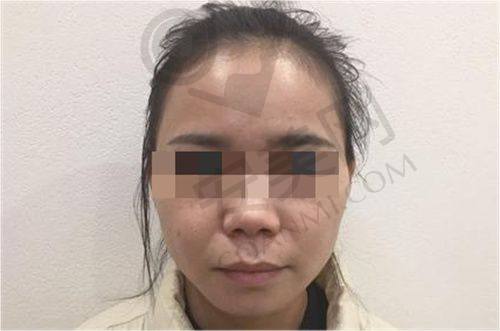 上海虹桥医院拇外翻专科李茂盛医生拇外翻矫正怎么样？