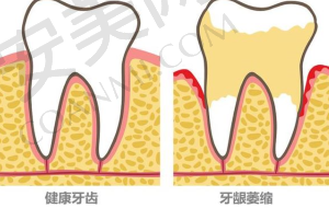 爱尔创全瓷牙是什么？