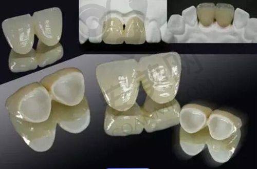 正雅隐形矫正的过程是怎样的？