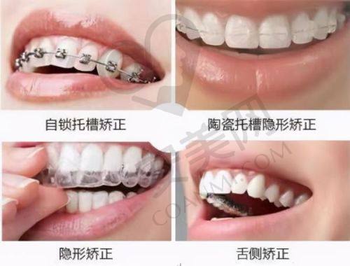 戴上BPS吸附性义齿后，感觉如何？