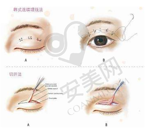 北京加减美面部提升的成效能维持多久？