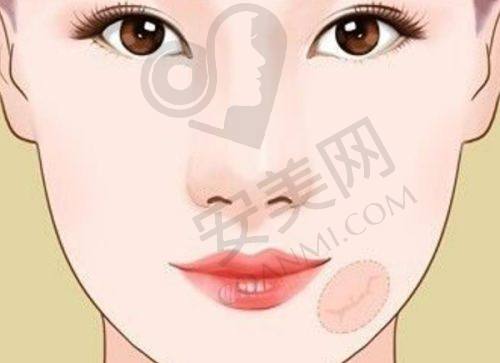 为什么选择成都美容整形医院冯春雨医生进行大腿吸脂？
