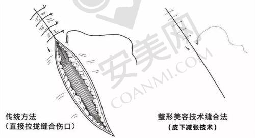 大腿吸脂后的成效如何，我是否满意？