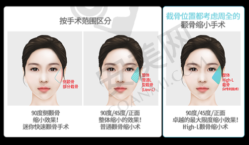 选择双眼皮修复医院的注意事项