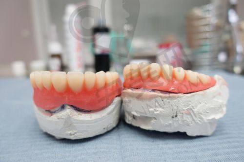北京劲松口腔 all - on - 4 全口牙种植的成功实例多吗？