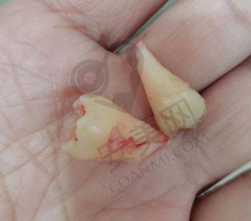 广州广大口腔医院超微舒适拔不完全阻生智齿技术优势在哪？