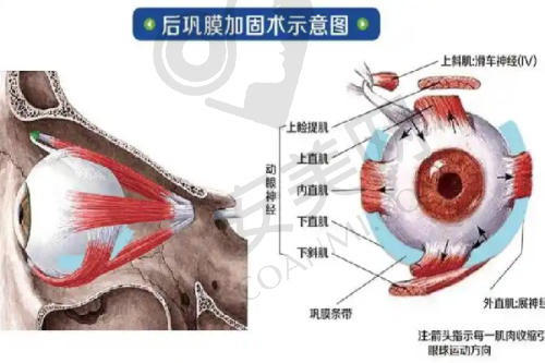 自体脂肪丰臀相关知识科普