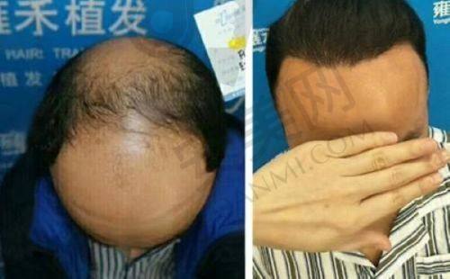 北京碧莲盛植发的术后成效如何？
