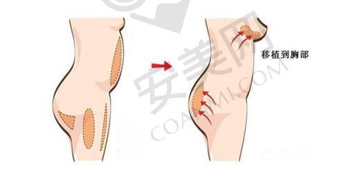 哪些人适合做6D睑緣切开明星眼？