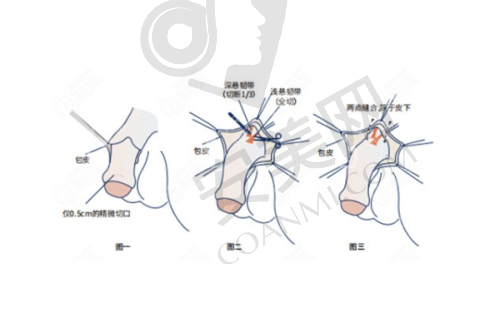 北京黄寅守面部拉皮有哪些风险？