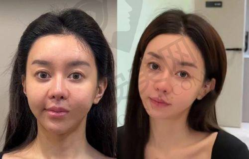 北京加减美拉皮手术的价格合理吗？