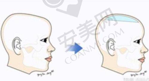 上海华美幼态脸打造术后修复快吗？