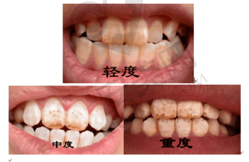 牙齿美容与修复：展现自然美学