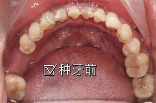 佩戴全口假牙有哪些注意事项？