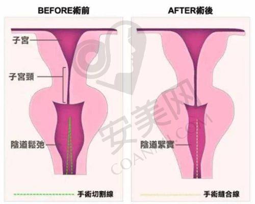 如何降低在重庆骑士医院大脚骨整形的费用？