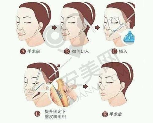 北京加减美拉皮手术的成效怎么样？