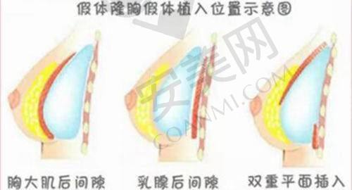 嗨体去颈纹有哪些注意事项？