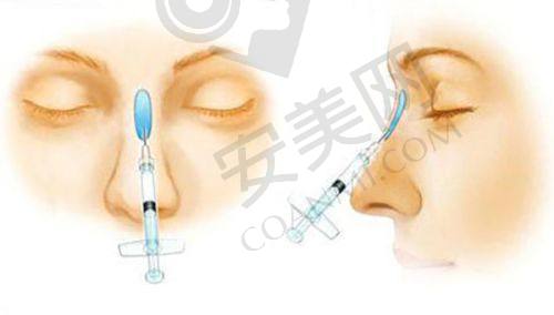 上海华美医院嗨体去颈纹的优势有哪些？