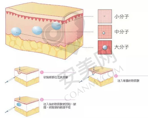 北京紫洁与其他去眼袋方法相比，不开刀去眼袋可靠吗？
