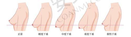 七台河割双眼皮医院推荐
