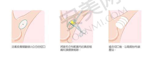 上海华美打玻尿酸塑轮廓，医生专精吗？