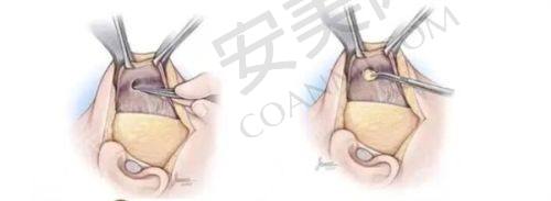 内外轮廓固定项目有风险吗？