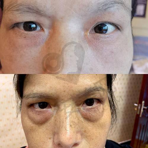 深圳去眼袋好的医院排名前10大揭秘