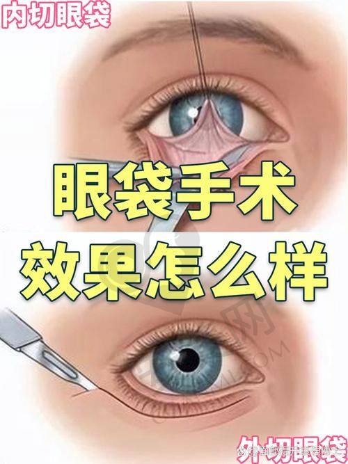 深圳去眼袋的正规医院排行榜前三名详解
