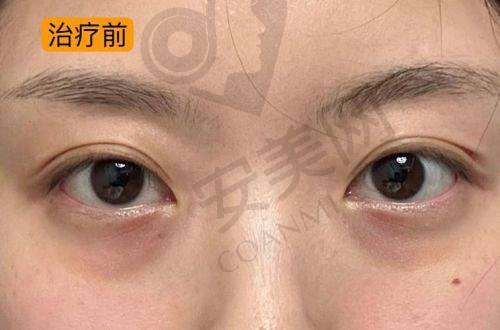 深圳祛眼袋医生排行榜及收费标准