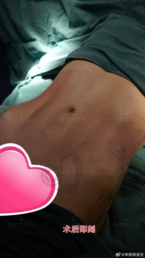 腰腹环吸的价格是如何确定的？