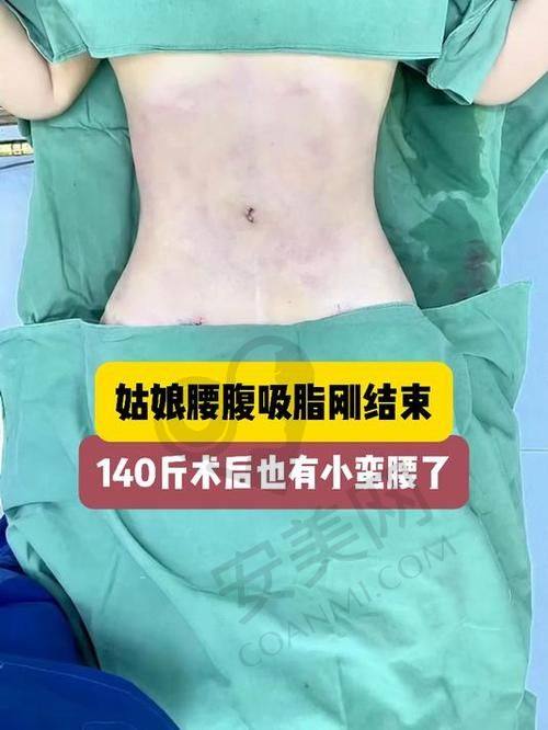 哈尔滨羽禅医美杨宇梓医生腰腹环吸16880元起，塑造迷人曲线开启美丽新生！ 