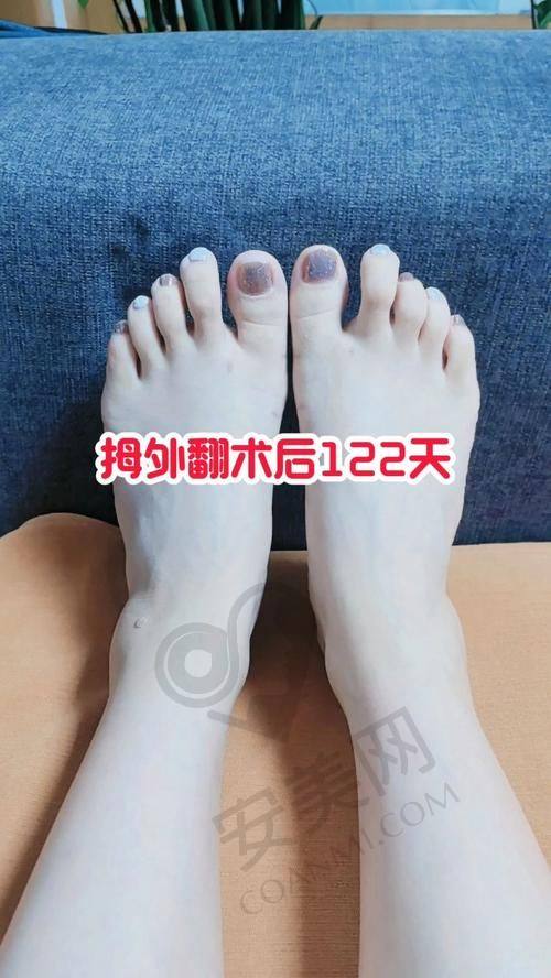 重庆骑士医院大脚骨整形有哪些优势？