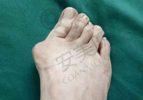 大脚骨整形术后修复需要注意什么？