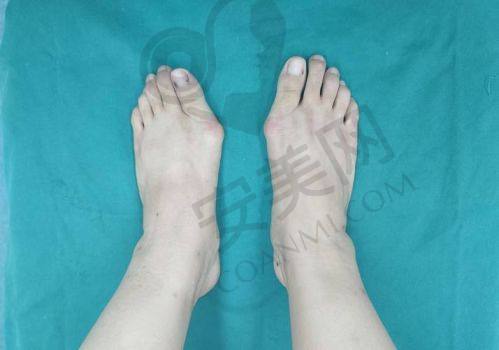 重庆骑士医院大脚骨整形的价格优势体现在哪里？