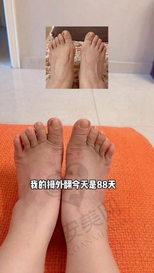 上海虹桥医院在大脚骨矫正领域的口碑如何？