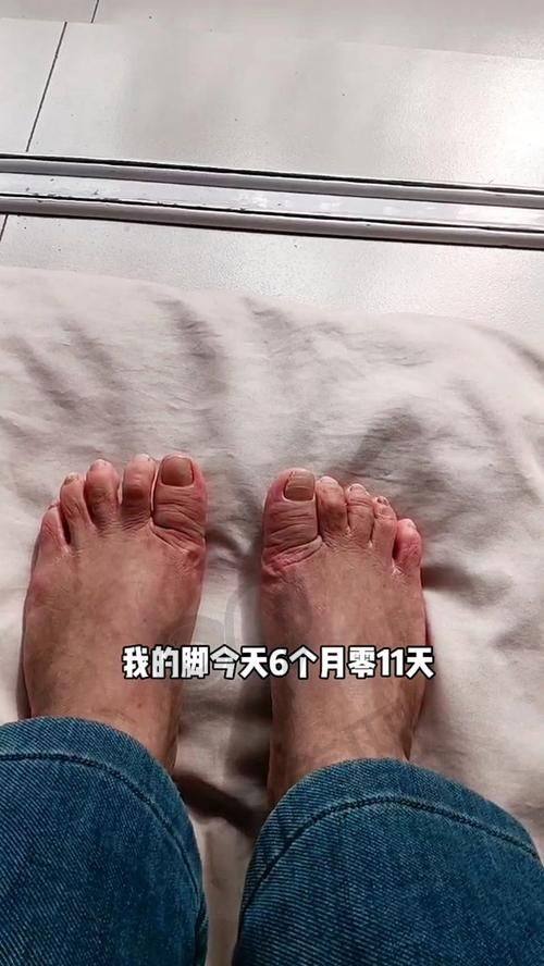 大脚骨整形术后修复需要注意什么？