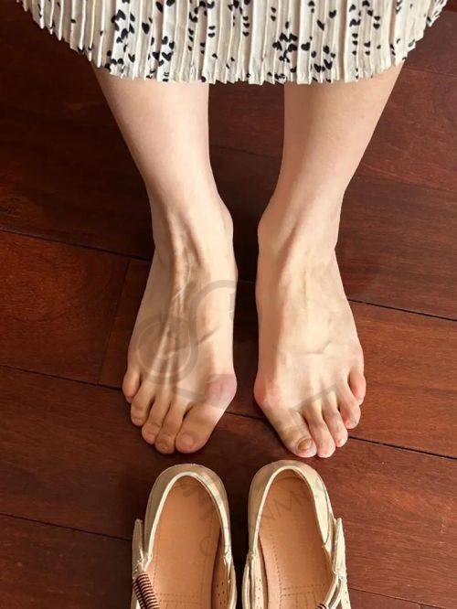 上海虹桥医院矫正大脚骨的治疗成效如何？
