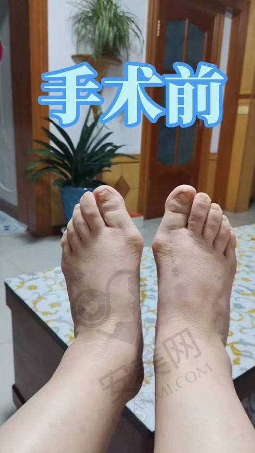 大脚骨整形手术过程是怎样的？